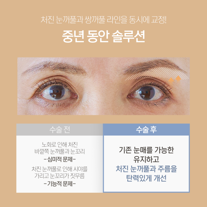 눈썹하거상술 흉터, 부작용 줄일 수 있는지 체크 1mm(일미리)성형외과