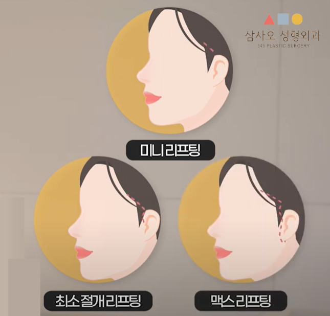 提升激光 vs 面部提升术的区别，适合我的提升方案与维持时间是？