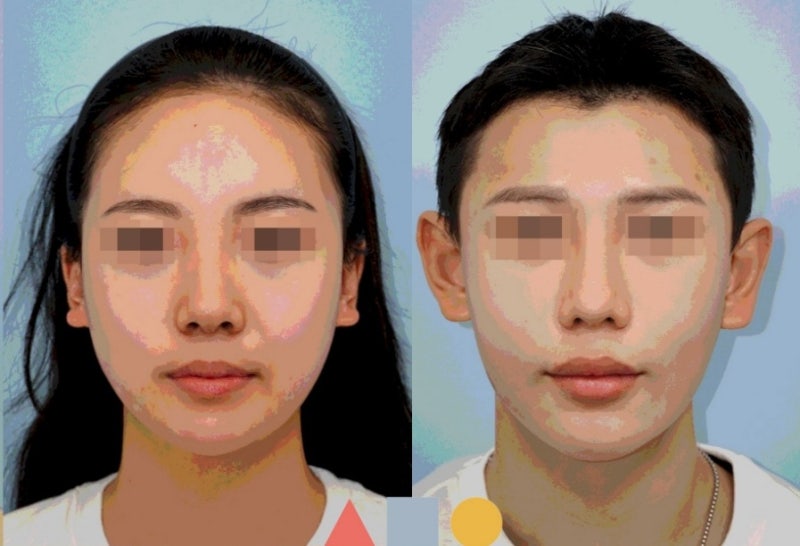Creating a Three-Dimensional Face with Facial Contouring Surgery: Dr. Park Jong-lim of Gangnam 345 Plastic Surgery Clinic