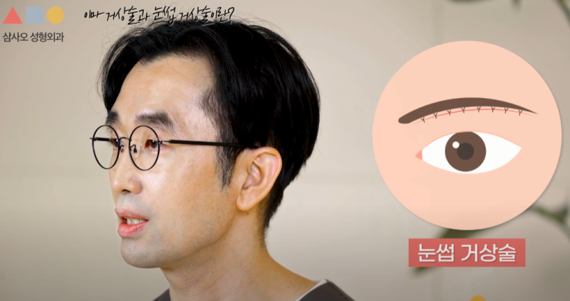 改善眼皮下垂：內視鏡額頭拉提 vs 提眉術的差異與適合我的手術方法
