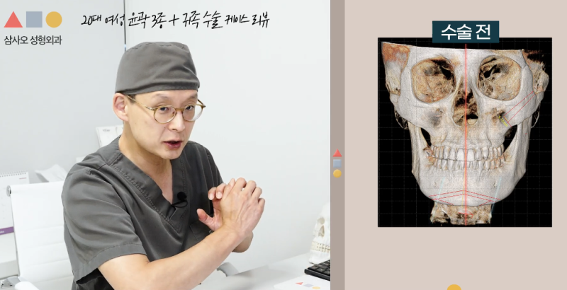 비대칭 얼굴 윤곽 3종 및 귀족수술 후기: 울퉁불퉁한 라인 개선법
