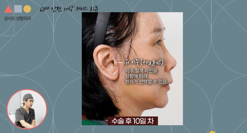 Facelift Review in Your 60s: A Complex Lifting Case Improving Both Sagging and Volume Loss Simultaneously