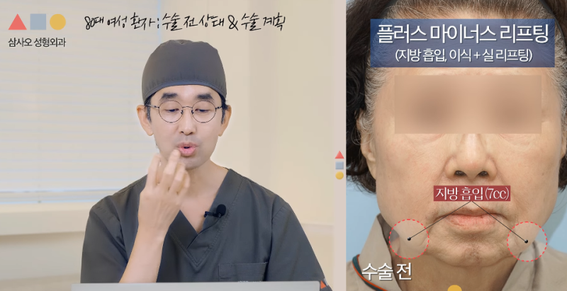 80多歲臉部下垂拉提：打造自然變化的Plus-Minus拉提效果與術後1年經過