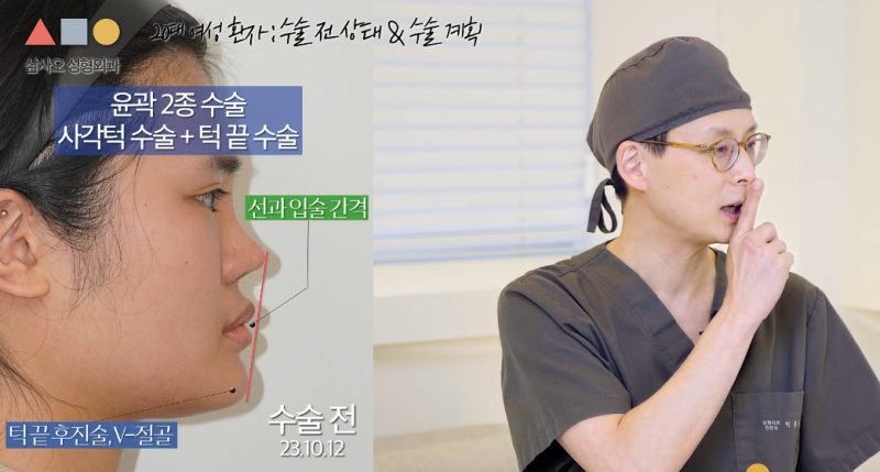 擺脫稜角臉！臉部輪廓兩件套（下顎角+下巴手術）20多歲女性真實案例