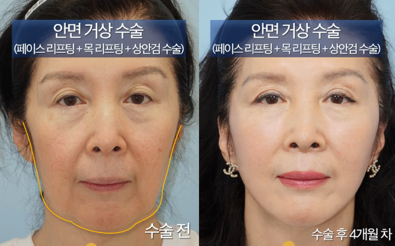 60대 안면거상 및 상안검 수술 사례: 심술보 제거와 자연스러운 리프팅