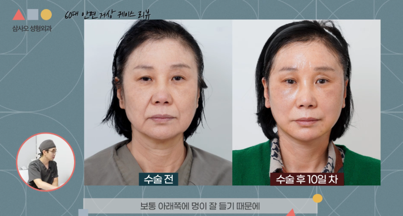 60대 안면거상 후기: 이마 내시경 리프팅 병행으로 완성한 동안성형 효과