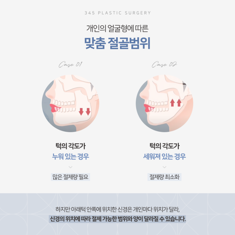 사각턱, 많이 깎는다고 예쁜 턱선이 될까요? 삼사오 긴곡선 사각턱 사진 4
