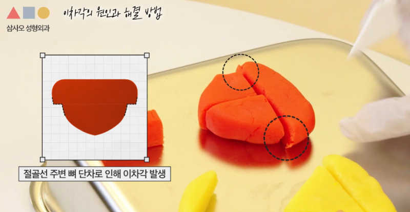 T절골? V절골? 나에게 더 적합한 앞턱수술 방법은? 사진 7