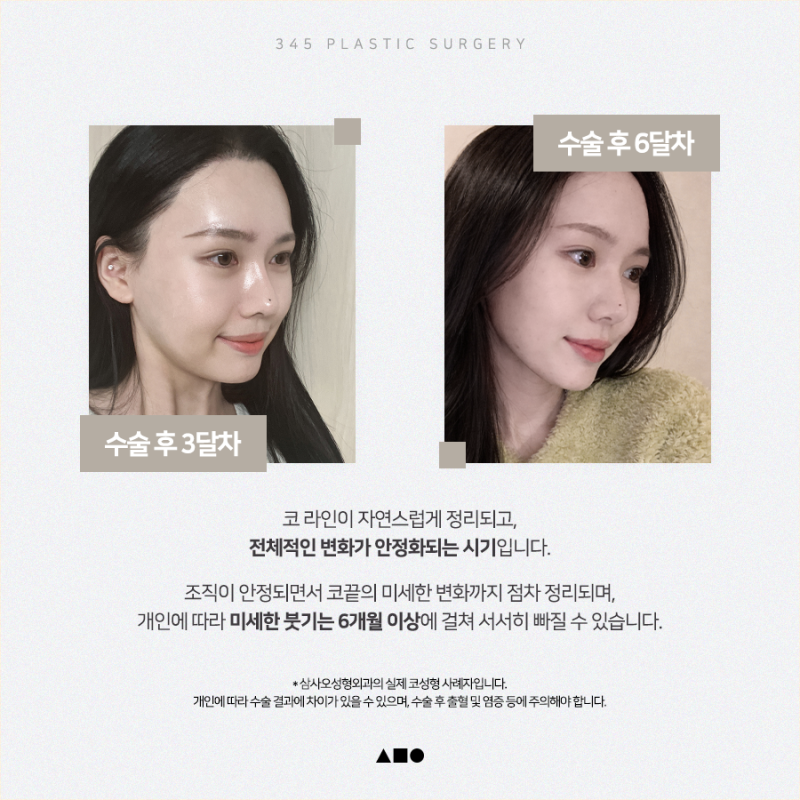 20대 여성 맞춤보형물 코성형 리얼 붓기 변화 사진 5