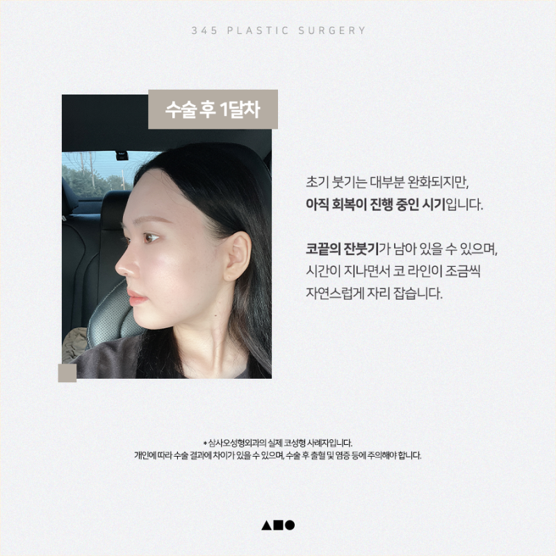20대 여성 맞춤보형물 코성형 리얼 붓기 변화 사진 3