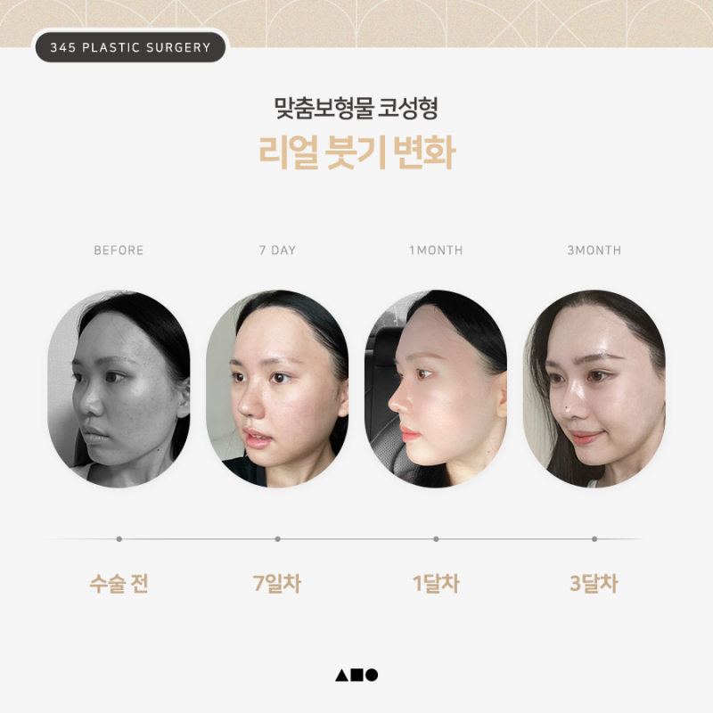 코수술 보형물 선택이 고민이라면? 삼사오 맞춤보형물 코성형 사진 6