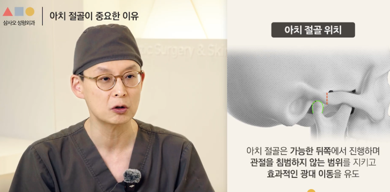 광대축소술, 절골 방식이 결과를 좌우합니다 사진 6