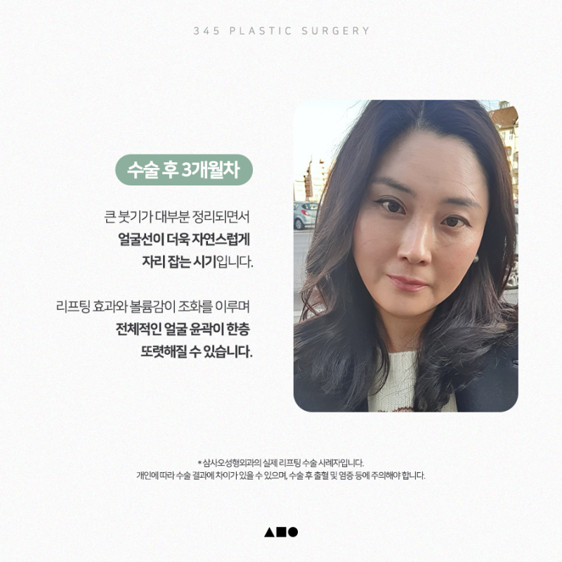안면거상, 얼굴지방재배치 후 1개월부터 4개월까지 리얼 붓기 변화 사진 4