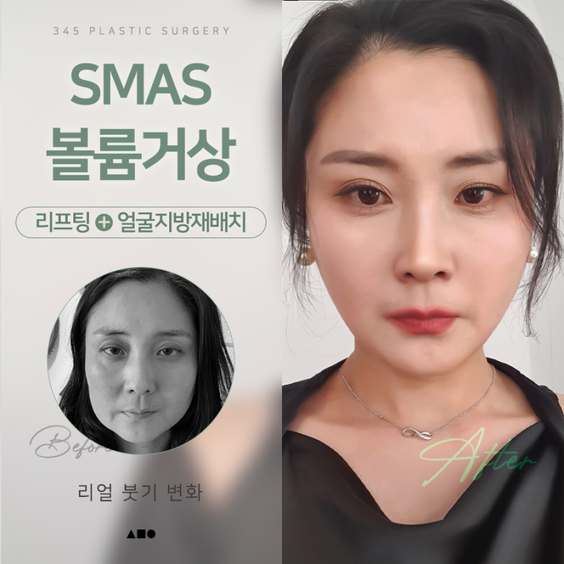안면거상, 얼굴지방재배치 후 1개월부터 4개월까지 리얼 붓기 변화
