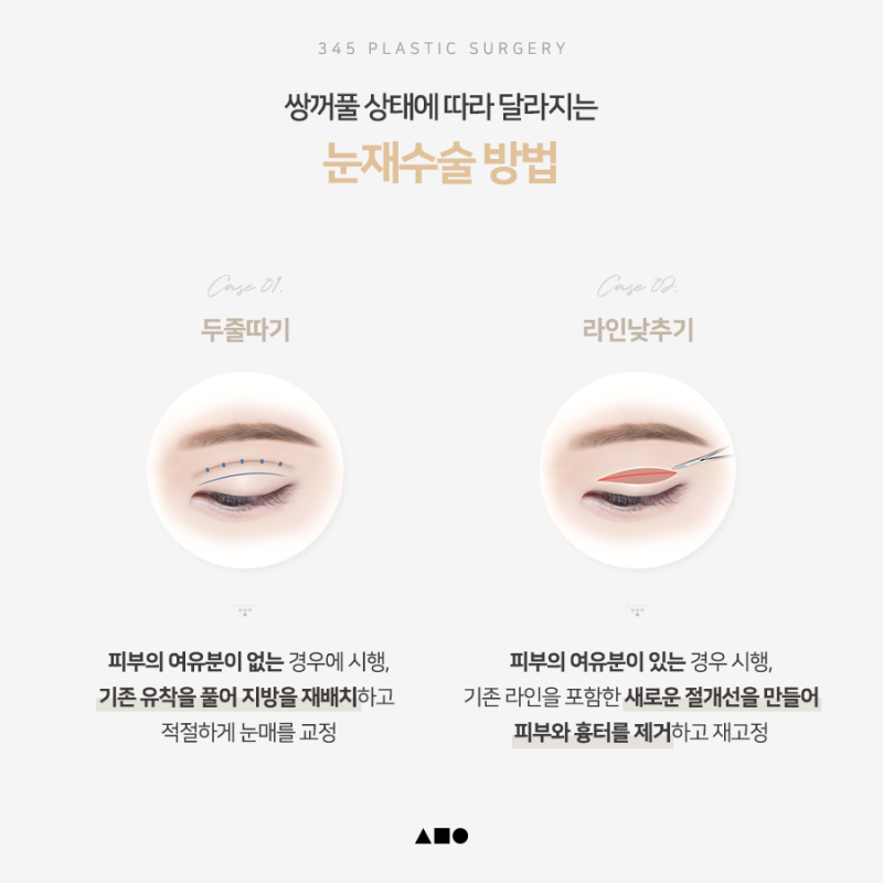 한쪽만 풀린 쌍꺼풀, 짝눈 교정 가능할까요? 사진 5