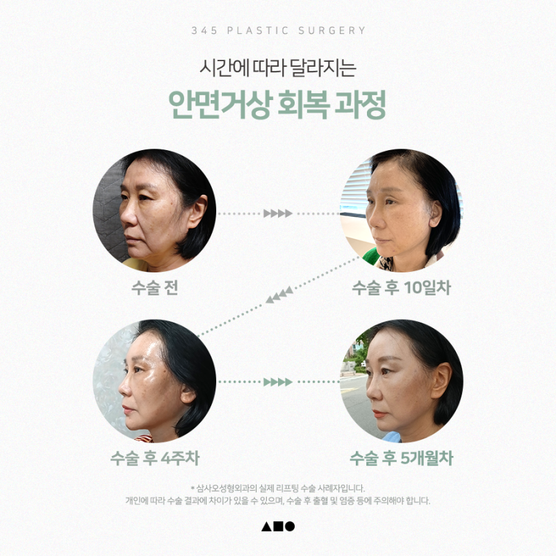 추석 전 안면거상, 언제 수술해야 자연스러울까요? 사진 3