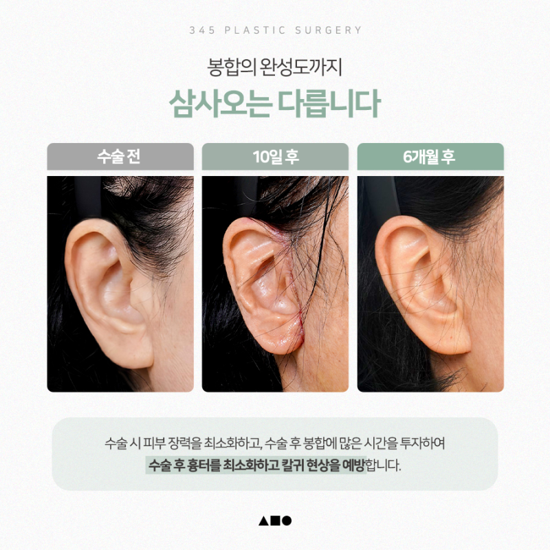 추석 전 안면거상, 언제 수술해야 자연스러울까요? 사진 6