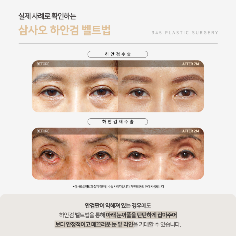 하안검 수술 잘하는 곳 찾을 때 확인해야 할 것은? 사진 5