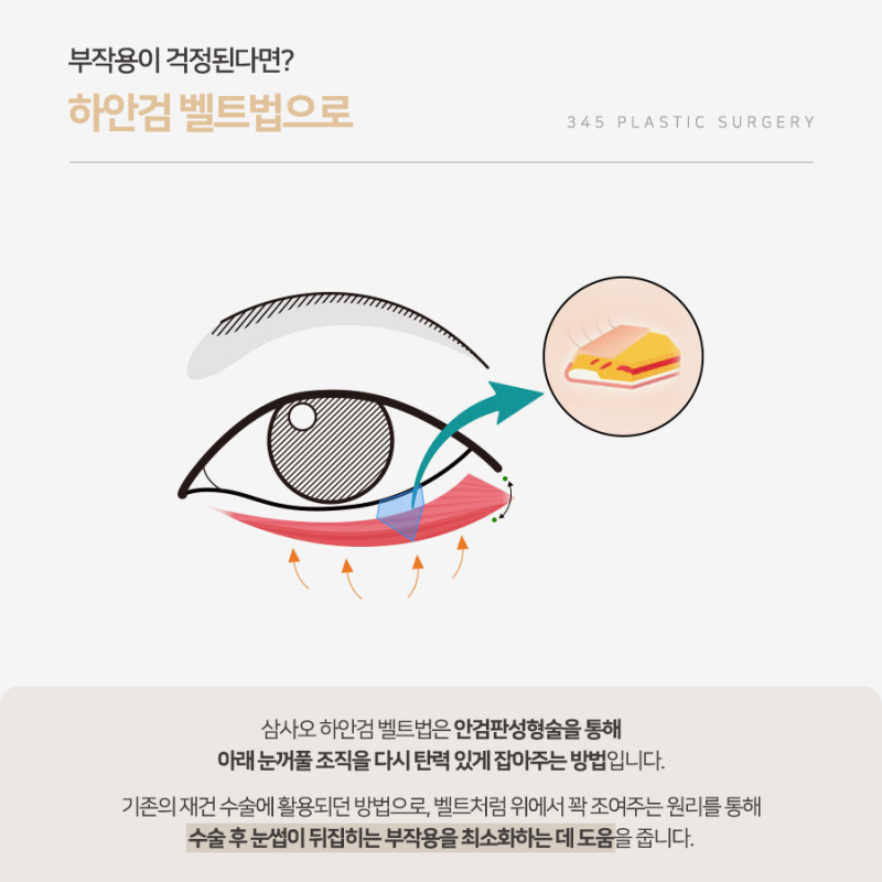 하안검 수술 잘하는 곳 찾을 때 확인해야 할 것은? 사진 3