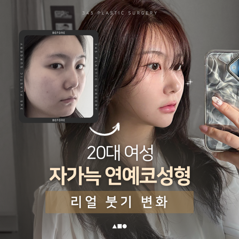 20대 여성 무보형물 연예코 (자가늑) 리얼 붓기 변화