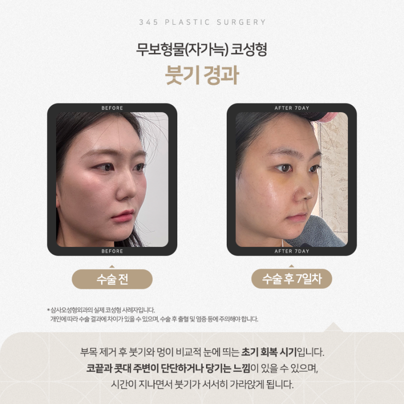 20대 여성 무보형물 연예코 (자가늑) 리얼 붓기 변화 사진 2