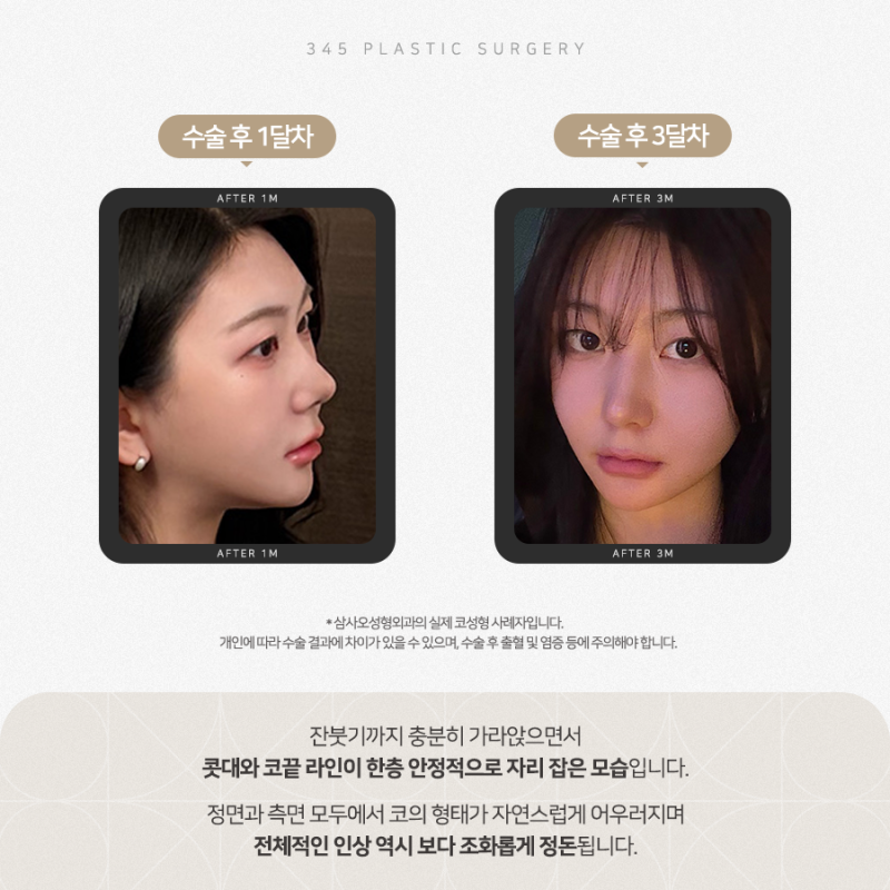 20대 여성 무보형물 연예코 (자가늑) 리얼 붓기 변화 사진 5
