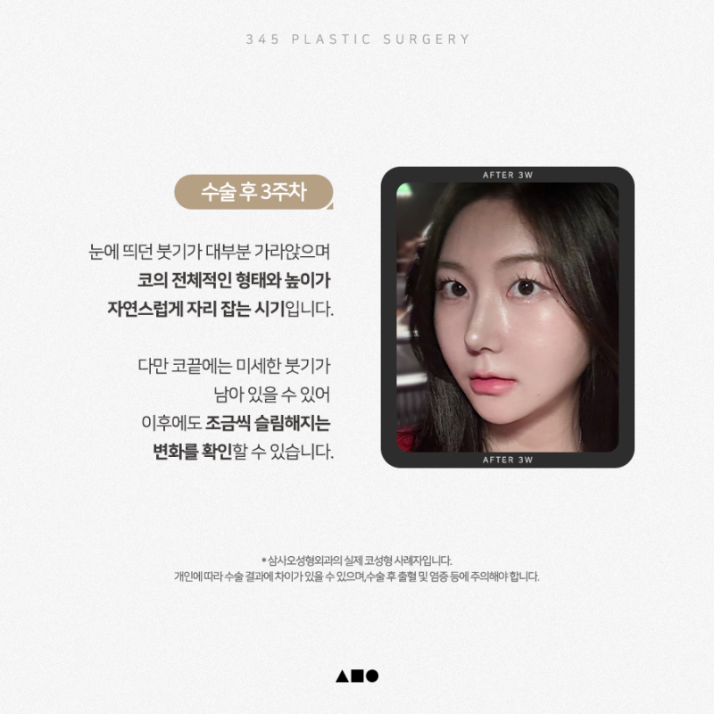 20대 여성 무보형물 연예코 (자가늑) 리얼 붓기 변화 사진 4
