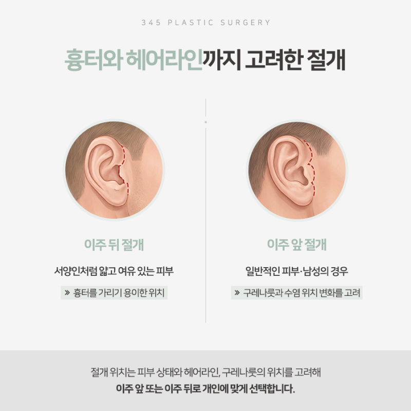남자 안면거상, 처진 얼굴선이 고민이라면 확인할 점 사진 4