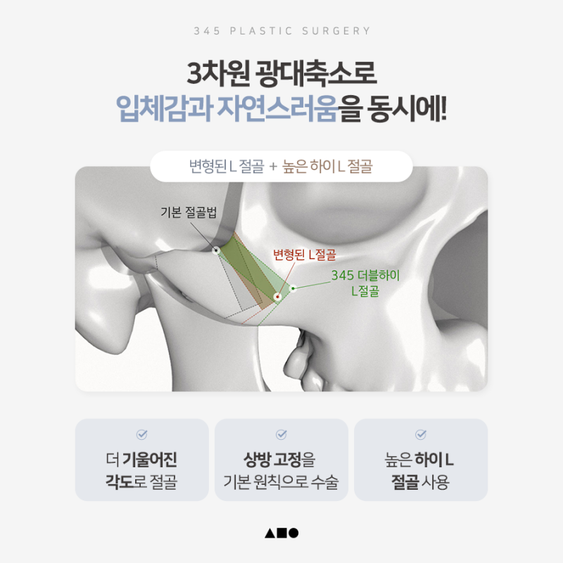 광대축소술 전 알아야 할 3차원 광대 구조와 수술 방법 사진 2