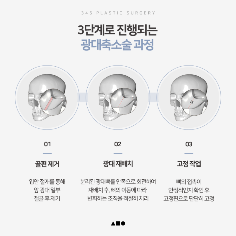 광대축소술 전 알아야 할 3차원 광대 구조와 수술 방법 사진 3
