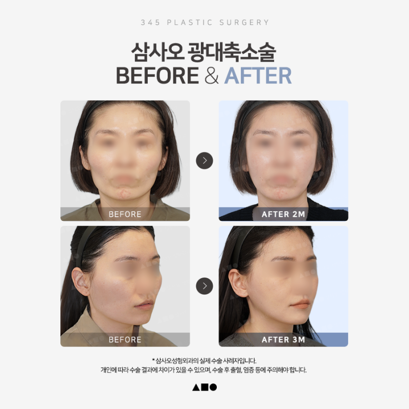 광대축소술 전 알아야 할 3차원 광대 구조와 수술 방법 사진 6