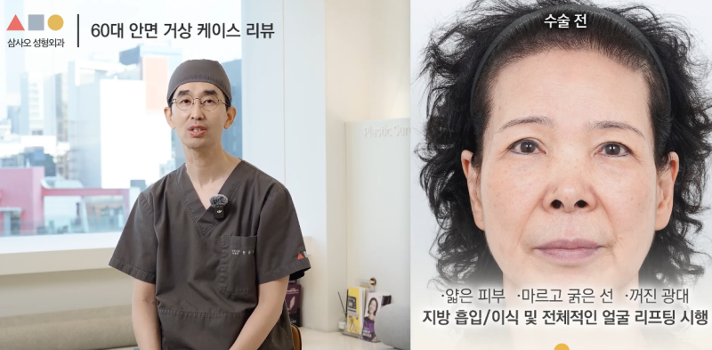 실제 경과로 확인하는 안면거상, 중요한 포인트는? 사진 5