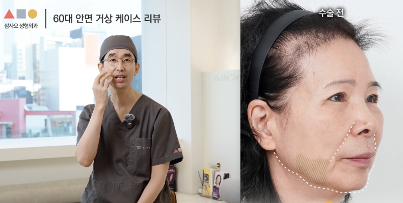실제 경과로 확인하는 안면거상, 중요한 포인트는? 사진 4