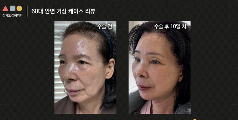실제 경과로 확인하는 안면거상, 중요한 포인트는? 사진 13