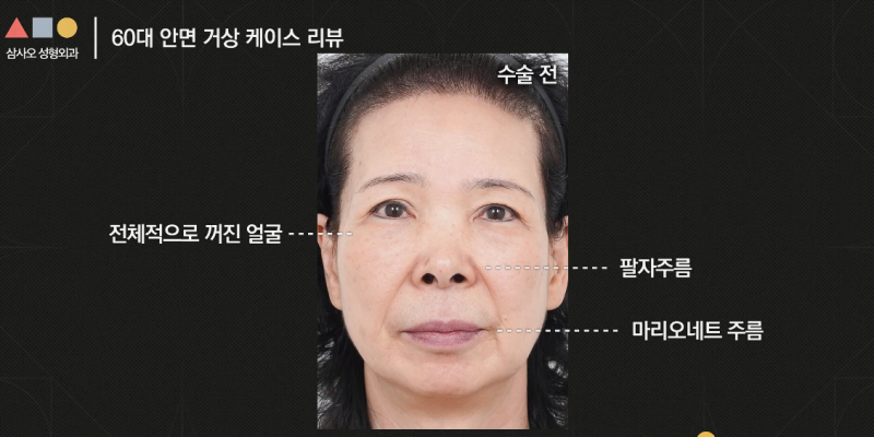 실제 경과로 확인하는 안면거상, 중요한 포인트는? 사진 3