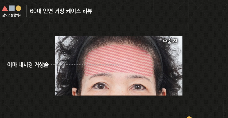실제 경과로 확인하는 안면거상, 중요한 포인트는?