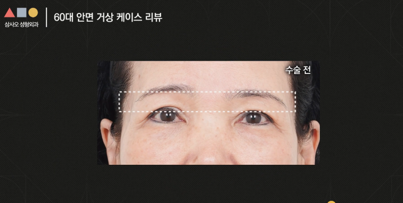 실제 경과로 확인하는 안면거상, 중요한 포인트는? 사진 6
