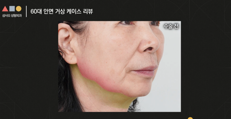 실제 경과로 확인하는 안면거상, 중요한 포인트는? 사진 8