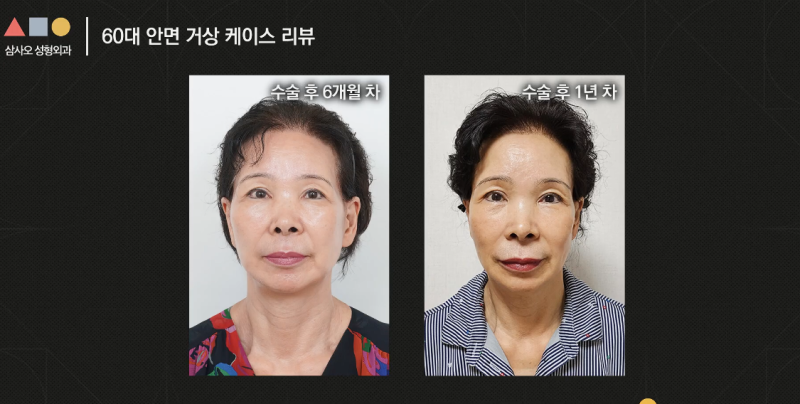 실제 경과로 확인하는 안면거상, 중요한 포인트는? 사진 15