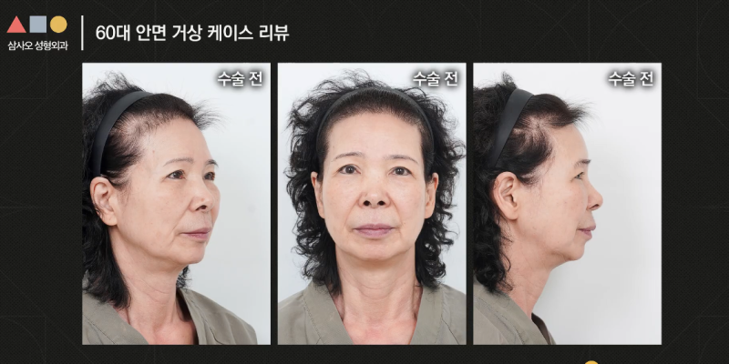 실제 경과로 확인하는 안면거상, 중요한 포인트는? 사진 2