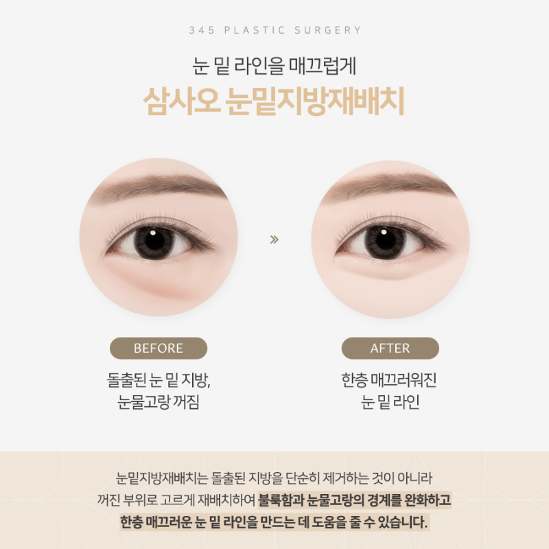 화장으로도 안 가려지는 눈 밑 그늘의 원인은? 삼사오 눈밑지방재배치 사진 3