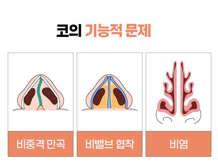 부산코재수술의 원인을 제대로 파악하여 마지막 수술이 될 수 있게
