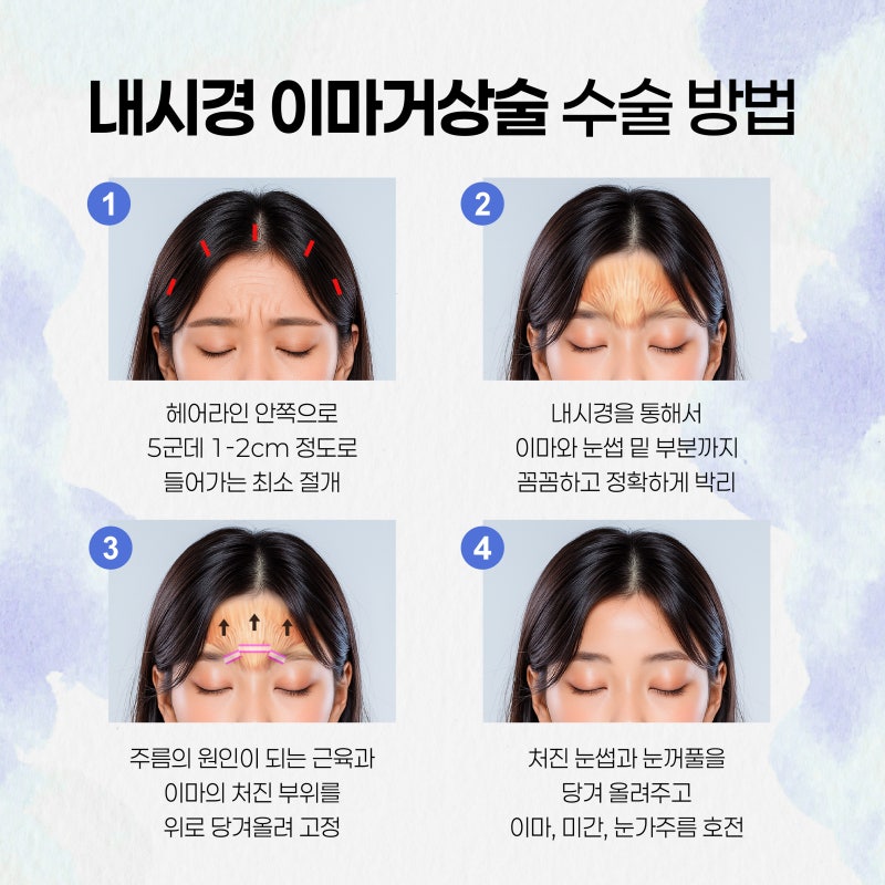 부산이마거상술, 내시경으로 정밀하게 당겨 자연스러운 변화