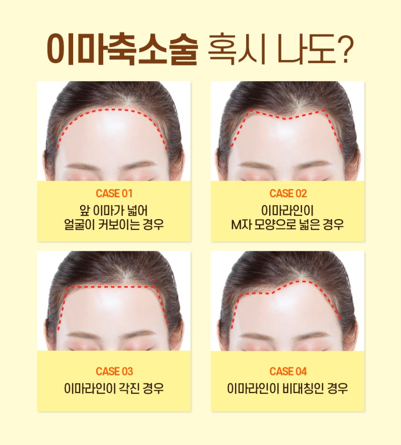 부산이마축소 넓은 이마가 고민이라면