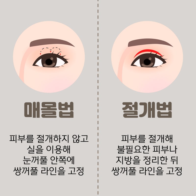 눈성형 결과를 좌우하는 핵심 요소는 무엇일까