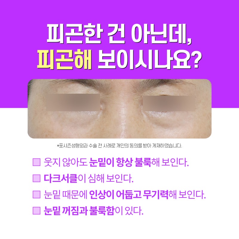 부산눈밑지 애교살은 남기고 눈밑지방만 깔끔하게