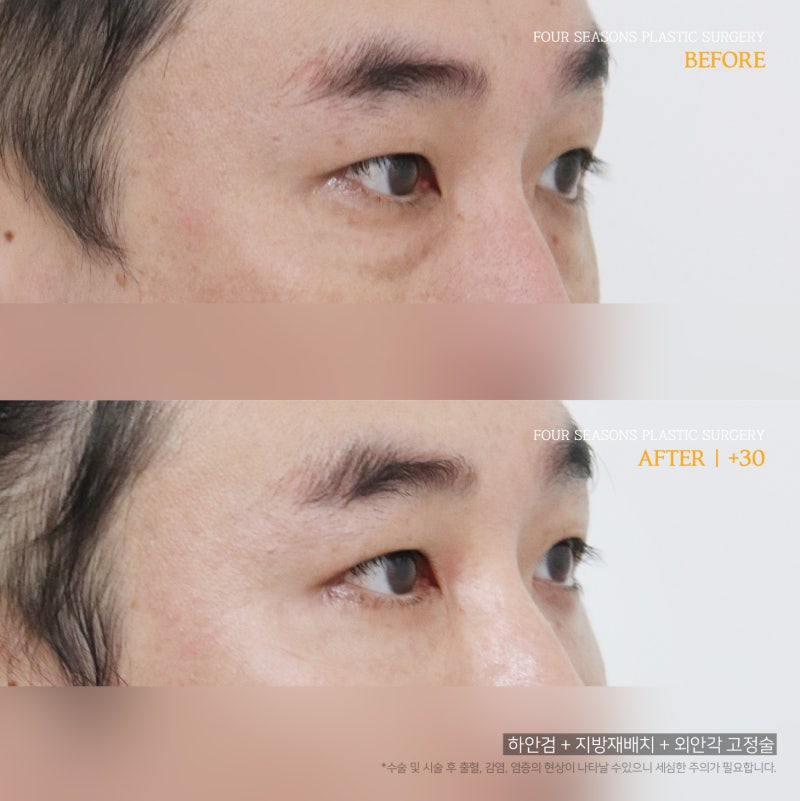 서면하안검수술 수술 비용이 달라지는 이유 사진 6