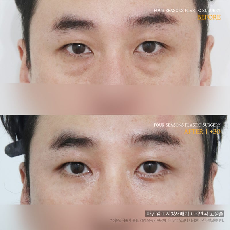 서면하안검수술 수술 비용이 달라지는 이유 사진 4