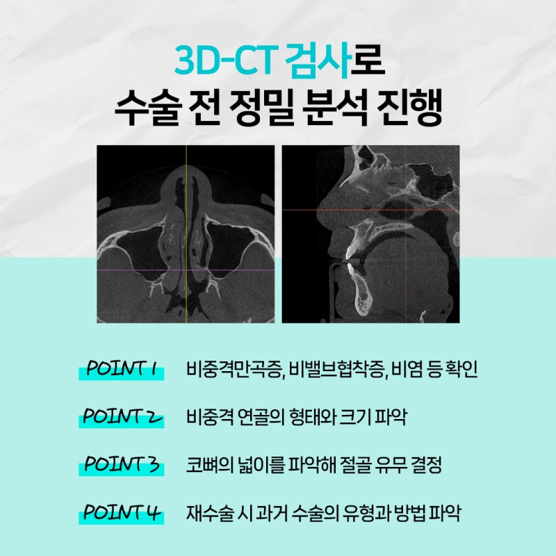 부산기능코 구조적 비염과 외형 개선을 동시에 사진 4