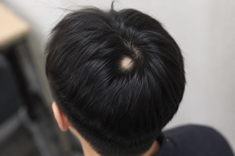대치역 탈모병원 <진료> 청소년 원형탈모 평생 관리해야 하나요?